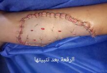 إنقاذ طفلة من كارثة صحية بعد عقر كلب.. وجراحة تجميلية ناجحة بدسوق العام