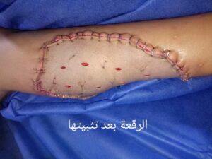 إنقاذ طفلة من كارثة صحية بعد عقر كلب.. وجراحة تجميلية ناجحة بدسوق العام