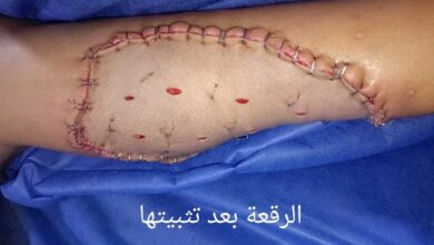 إنقاذ طفلة من كارثة صحية بعد عقر كلب.. وجراحة تجميلية ناجحة بدسوق العام