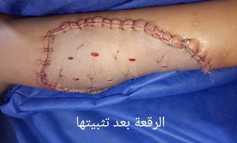 إنقاذ طفلة من كارثة صحية بعد عقر كلب.. وجراحة تجميلية ناجحة بدسوق العام